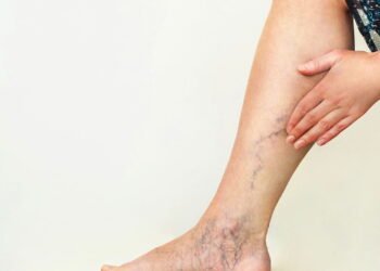 O remédio natural mais poderoso usado no alívio das varizes