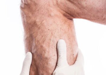 O remédio natural mais poderoso usado no alívio das varizes