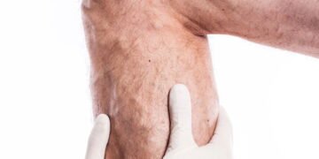 O remédio natural mais poderoso usado no alívio das varizes