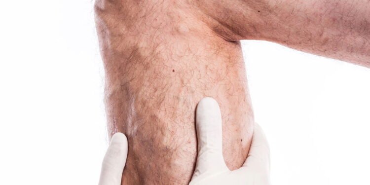 Varizes - Créditos: depositphotos.com / fotoevent.stock