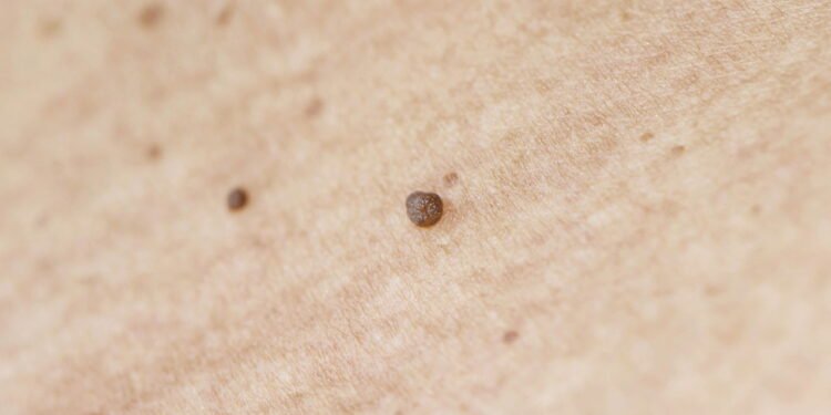 Ficar livre das verrugas no pescoço - Créditos: depositphotos.com / rosedepositmyphotos