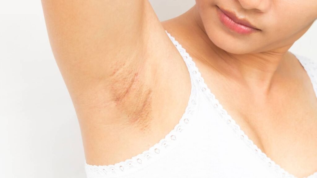 Receita natural mais eficaz para clarear as axilas e virilhas em casa