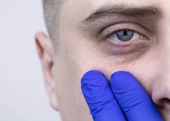 Elimine olheiras de forma rápida utilizando esse creme natural