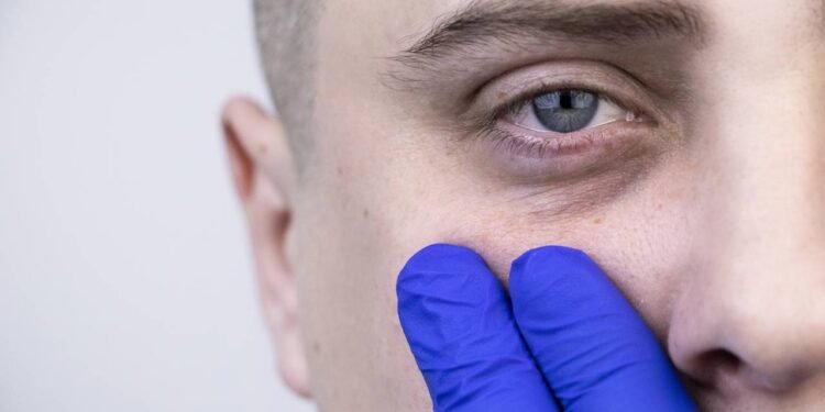 Elimine olheiras de forma rápida utilizando esse creme natural