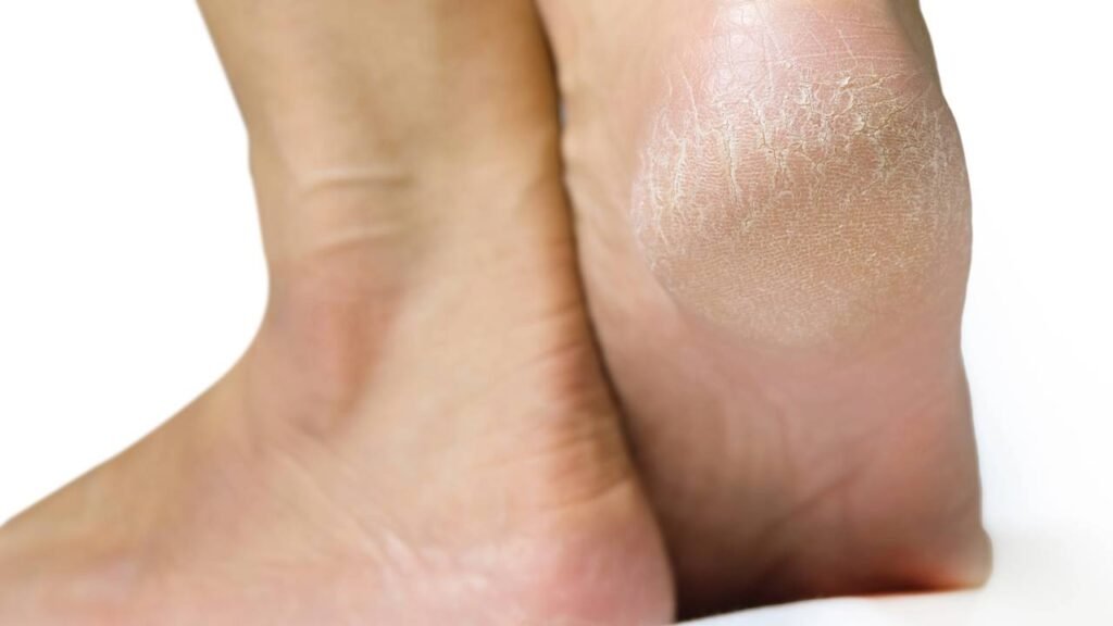 Como acabar com as rachaduras dos pés enquanto dorme com apenas 3 ingredientes