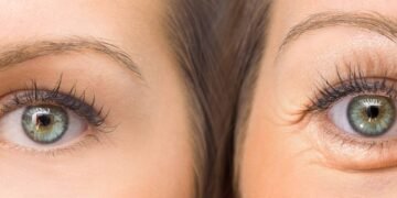 Acordou com bolsas nos olhos? Veja como diminuir o inchaço matinal