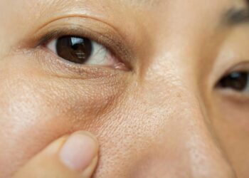 Acordou com bolsas nos olhos? Veja como diminuir o inchaço matinal