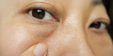 Acordou com bolsas nos olhos? Veja como diminuir o inchaço matinal