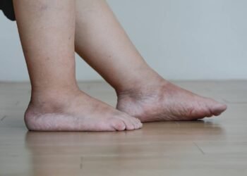 Cansada de pernas inchadas? Esta planta pode ser a resposta certa