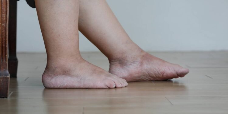 castanha da índia pode ser uma ótima solução - Créditos: depositphotos.com / toa55