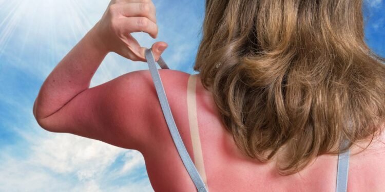 Com a chegada do verão, as férias e a exposição ao sol tornam-se frequentes - Créditos: depositphotos.com / vchalup2