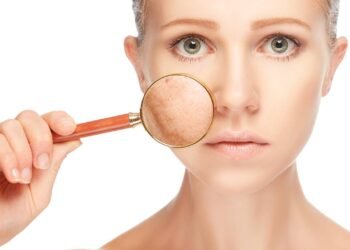 Você tem sardas? Saiba como prevenir o surgimento delas