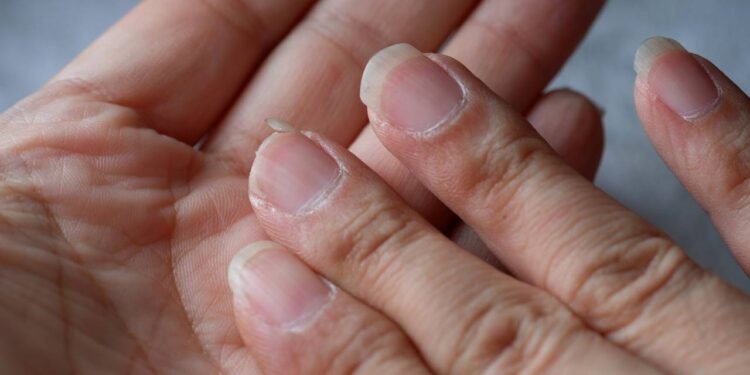 O sabor amargo do alho e do limão vai desencorajar de forma natural o hábito de roer as unhas - Créditos: depositphotos.com / wisely