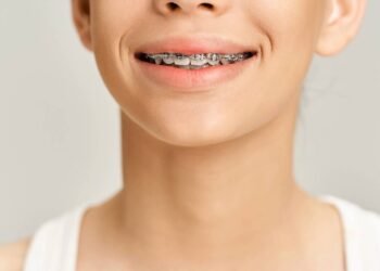 Aparelho invisível ou fixo? Veja prós e contras