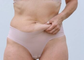 O risco inesperado da flacidez após perda de peso