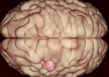 Dr. Baltazar Leão: o tratamento mais eficaz da metástase cerebral continua evoluindo