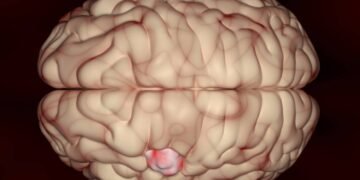 Dr. Baltazar Leão: o tratamento mais eficaz da metástase cerebral continua evoluindo