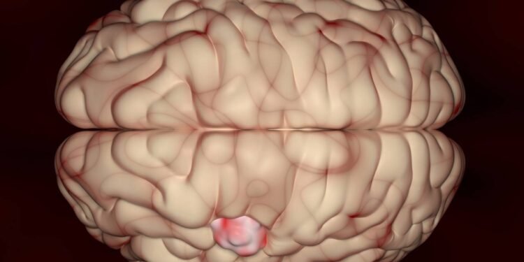 Metástase Cerebral - Créditos: depositphotos.com / forfour