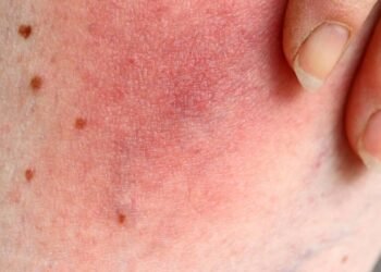 Como proteger a pele sensível do calor sem sofrer com coceiras e vermelhidão