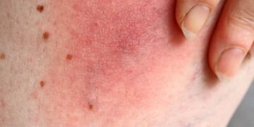 Como proteger a pele sensível do calor sem sofrer com coceiras e vermelhidão