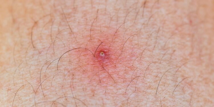 3 receitas para acabar com os pelos encravados de forma rápida e fácil