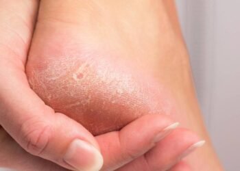 O cuidado diário que evita rachaduras nos pés mesmo nos dias mais quentes