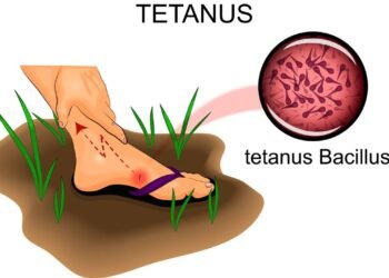 O sintoma mais assustador do tétano que poucos notam