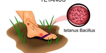 O sintoma mais assustador do tétano que poucos notam