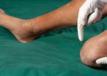 Homem recebe indenização de 7,4 milhões por invalidez permanente devido à negligência médica e hospitalar