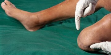 Homem recebe indenização de 7,4 milhões por invalidez permanente devido à negligência médica e hospitalar