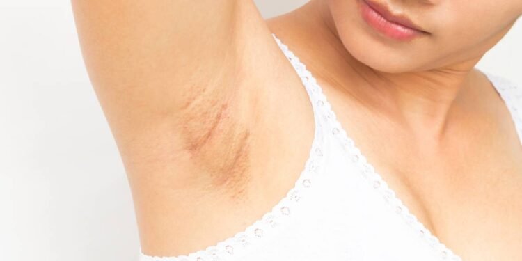 O escurecimento das axilas é causado por fatores variados- Créditos: depositphotos.com / mraoraor