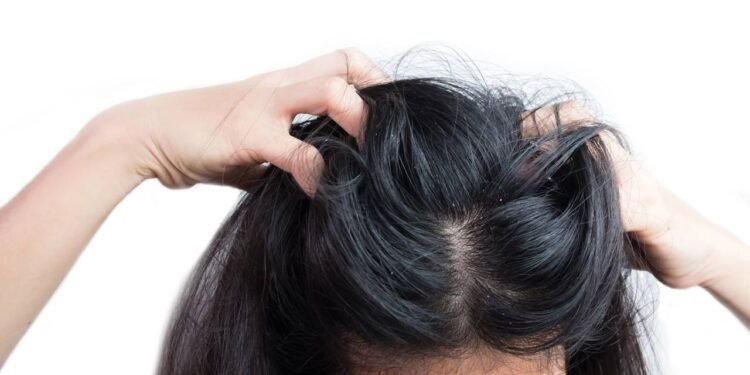 A caspa é uma condição frequente do couro cabeludo - Créditos: depositphotos.com / sirinatestocker.gmail.com