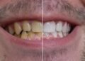 Alimentos e bebidas que deixam os dentes amarelados, segundo dentista