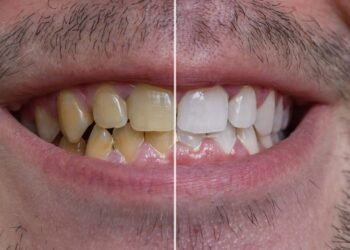 Alimentos e bebidas que deixam os dentes amarelados, segundo dentista