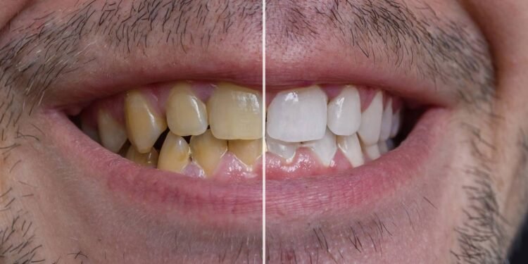 Hábitos simples que devolvem o brilho natural dos dentes - Créditos: depositphotos.com / vchalup2
