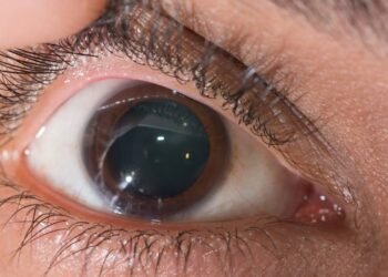 Dra. Tayuane Pinto, Oftalmologista: Por que seu exame de vista pode exigir dilatação da pupila?