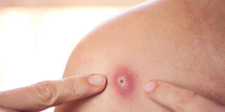 Os pelos encravados causam dor e desconforto - Créditos: depositphotos.com / dexteris