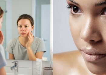 Diga adeus à pele oleosa com dois ingredientes que você já tem na sua casa