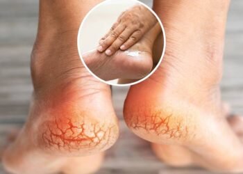 Seus calcanhares estão rachando? Essa mistura de 3 ingredientes resolve em poucas noites