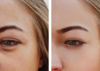 Tinha olheiras profundas há anos, esse truque caseiro fez milagres no meu rosto