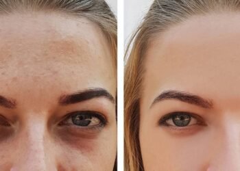 Tinha olheiras profundas há anos, esse truque caseiro fez milagres no meu rosto