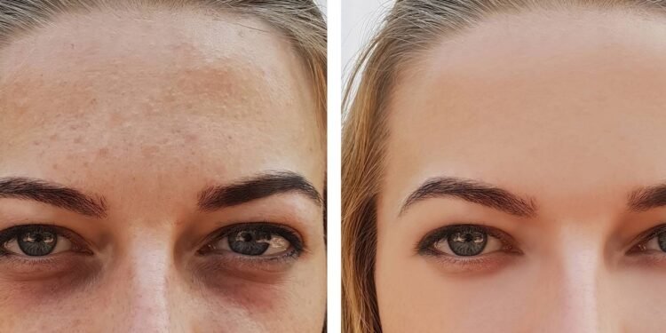 Mudar pequenos hábitos do dia a dia pode ajudar a diminuir a aparência das olheiras - Créditos: depositphotos.com / TanyaLovus