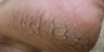 Pare de sofrer com dores nos calcanhares e aprenda a fazer este cicatrizante natural