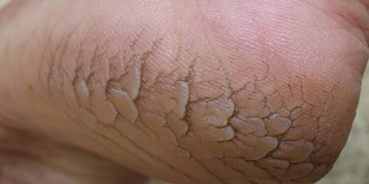 Pés ressecados podem doer e gerar desconforto - Créditos: depositphotos.com / eyepark