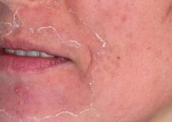 Sua pele implora por socorro depois de um procedimento dermatológico