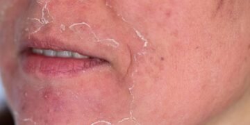 Sua pele implora por socorro depois de um procedimento dermatológico