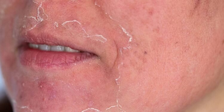 Após o peeling sua pele fica sensível - Créditos: depositphotos.com / Saaaaa