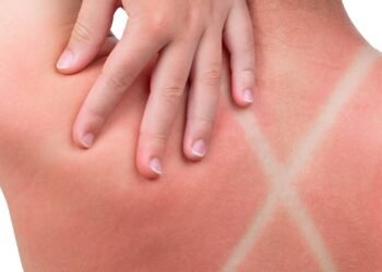 Essa mistura caseira é tudo o que sua pele precisa depois de um dia inteiro no sol