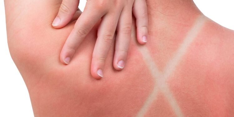 Depois de um dia intenso de sol, ela fica sensível e pode descascar - Créditos: depositphotos.com / Artiom.photo