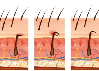 O jeito certo e seguro de tirar um pelo encravado em casa sem machucar a pele